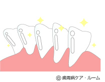 歯面研磨